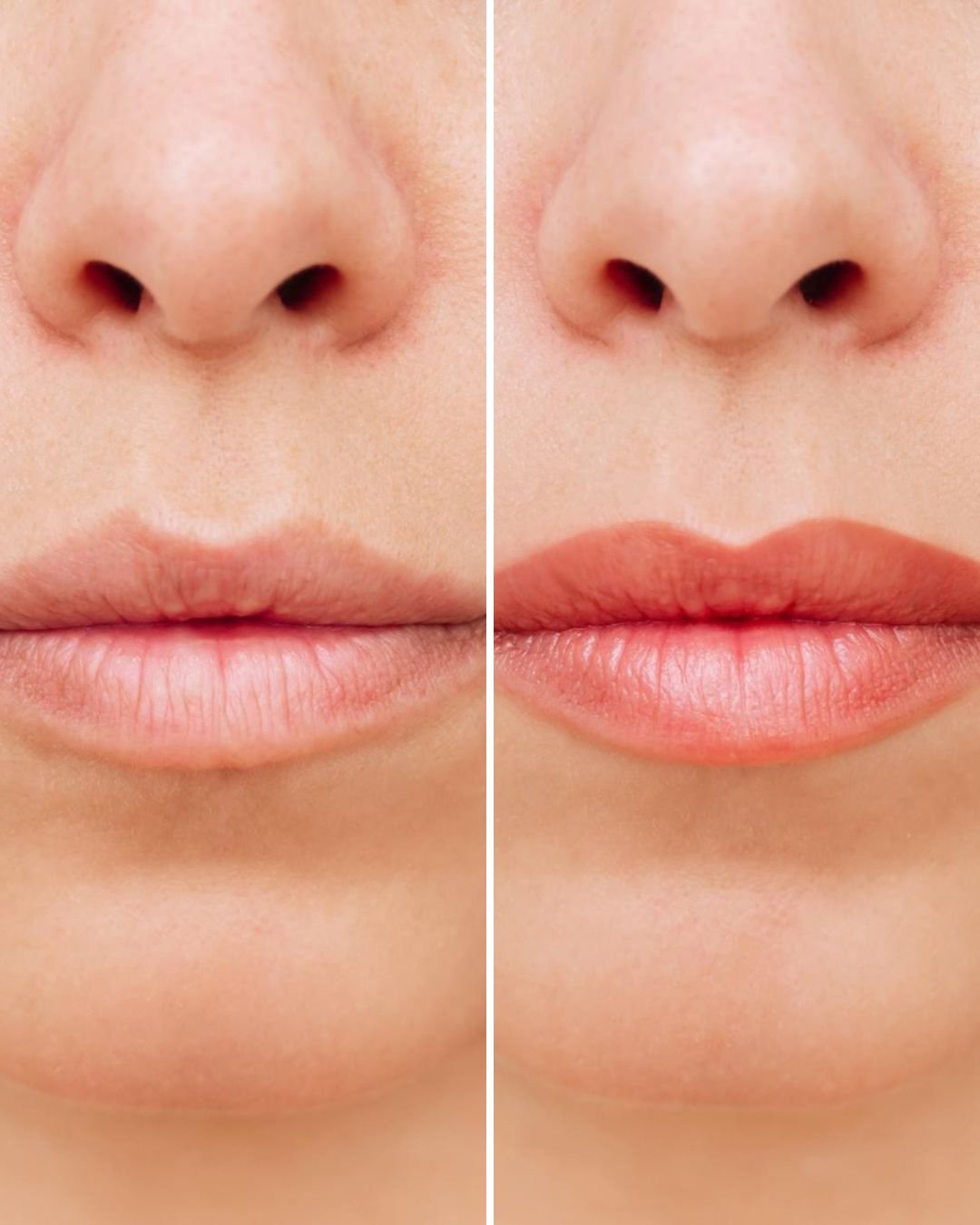 Lip Pigmentation Treatment